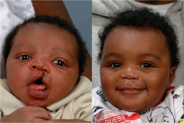 Cleft lips, palates: the birth defect that steals babies' smiles - Vimarsana News